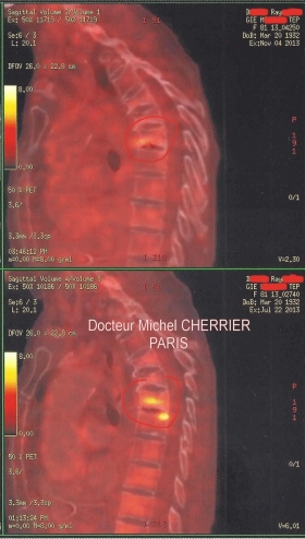 IMAGES DE LA COLONNE VERTEBRALE DORSALE DE PROFIL - Clinique du mal au dos
